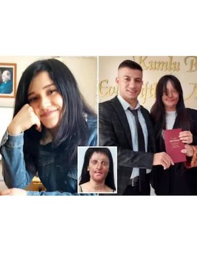 In 2019, Berfin Ozek was left blind in one eye and permanently disfigured after  her ex boyfriend allegedly att+cked her with sulfuric acid. Following his  prison sentence, he reportedly began sending her