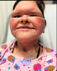 TBT August 2013 Your smile is the prettiest thing I have ever known even  during cancer with puffy steroid face and all … So beautiful!  #MathiasStrong #Smile #kidsgetcancertoo ❤️🎗️