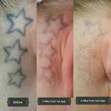 With this procedure, a medical professional will numb the skin with a local anesthetic. Tattoo Removal Eliminink Luna Plastic Surgery Johns Creek