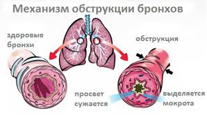 Bronhit Ostryj Hronicheskij Obstruktivnyj Mnogoprofilnyj Mediko Diagnosticheskij Centr