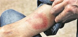Borreliose Verdacht Bei Unklarer Klinik Auf Serologiebefunde Warten