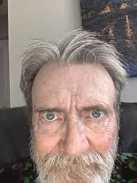 Eye color change after cataract surgery