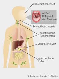 Research on infectious mononucleosis was also given priority over articles exclusively relating to. Pfeiffersches Drusenfieber Symptome Ansteckung Verlauf Netdoktor
