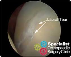 Image result for Hip Labral Tear