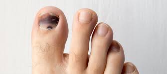 Listen Up Walkers And Runners Black Toenails Are Preventable Footfriend
