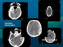 Scleroza multipla poate fi uneori dificil de diagnosticat, deoarece are simptome comune cu multe alte afectiuni. Leziuni Demielinizante In Substanta Alba Instiletende It