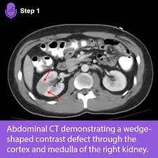 Image result for Renal Infarction