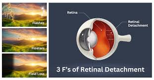 Image result for Retinal Detachment