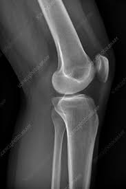 Image result for Knee XRay