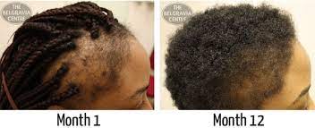 And you'll find cuts both long and short to suit your preference. Afro Caribbean Hair Loss