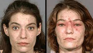 Meth Face Sores Scabs What Meth Does To Your Skin