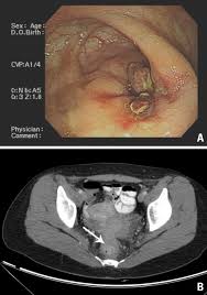 Bowel cancer symptoms are not always easy to spot as they can be mistaken for less serious health conditions. A Colonoscopic Finding Ulcerofungating Mass 8 Cm Above The Anal Download Scientific Diagram