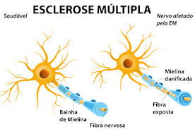 Embora a causa da doença ainda seja desconhecida, a em tem sido foco de muitos. Agosto Laranja Mes Da Conscientizacao Sobre Esclerose Multipla Amafresp