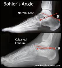 Image result for Calcaneus Compression Fracture