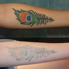Perfect body laser & aesthetics® offers the new cynosure revlite s.i. Serious About Removing Your Tattoo Here S The Most Effective Treatment Tattoo Removal Cost Laser Tattoo Tattoo Removal