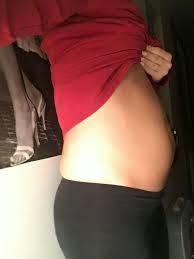 Endometriozis, derin yerleşimli endometriozis, barsak çıkarılması, deep endometriosis, segmental rectal resection, endometrioma, çikolata kisti. Terhesnek Tunt Az Endometriozisban Szenvedo Modell Nlc