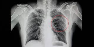 We did not find results for: Meski Dapat Sembuh Sendiri Patah Tulang Rusuk Harus Segera Ditangani