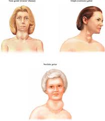 Goitre can also be caused or aggravated by the regular consumption of goitrogens such as manioc, cabbage, turnips, millet etc. Simple Goiter Atlas Of Pathophysiology 2 Edition