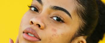 Skincare products to help keep breakouts at bay