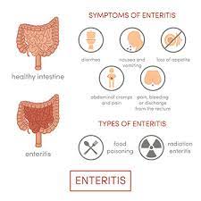Darmentzundung Enteritis Ursachen Symptome Behandlung Medlexi De