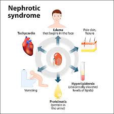 Hemolytic uremic syndrome in children. Ayurvedic Treatment Of Nephrotic Syndrome