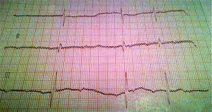 Symptoms and treatment depend on degree of block, but. Bloc Atrioventricular Congenital La Nou NÄscut Din MamÄ Cu Lupus Eritematos Sistemic Prezentare De Caz
