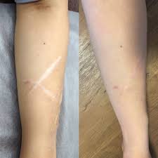 白い 傷跡 レーザー