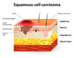 They feel others' pain and it could break them; Sun Damage And Cancer