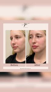 Nothing like a good lip enhancement with @jcaestheticsllc just in time for  the weekend!! 💋💋, ✨Make sure you’re photo ready