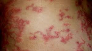 Image result for itchy skin rectum