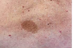 Vucuttaki Kirmizi Lekeler Ne Anlama Geliyor