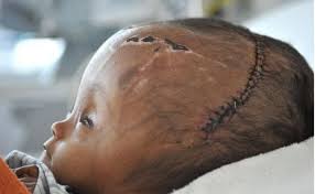 Pemasangan Cerebral Shunt Pada Penderita Hidrosefalus