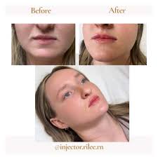 Lippies ✨💋 Don't forget to take advantage of May lip filler deals before  they're gone! #sknrgy #sknrgyaesthetics #medspatucson