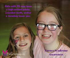 Turners Syndrome- Tulip