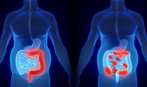Colitis Ulcerosa Symptome Verlauf Netdoktor At