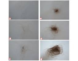 In this review, we are going to look at those treatments that are backed by evidence and discuss how they work so that you can make the best choice to treat your receding hairline. Hair Shedding Scale Scores Vary Between 1 Minimal Shedding To 6 Download Scientific Diagram