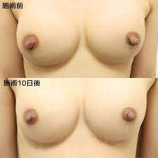 乳頭縮小術｜大きい乳首を小さくする！乳頭縮小手術の術後の経過・腫れ・痛み・ダウンタイム・値段について｜美容整形・美容外科のTAクリニックグループ