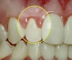 4.2 is treatment covered by medicare each displays different symptoms and requires a different type of treatment. Gum Disease Treatment Dentist In Mcdonough