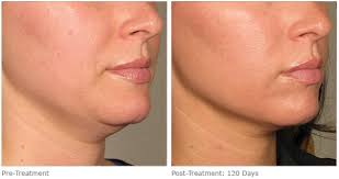 Ultherapy Vs Thermage Top Dermatologist In Nyc Dermatology And Laser Group