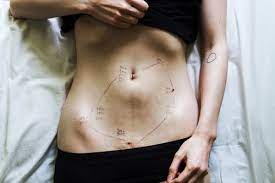 L'endometriosi può svilupparsi in varie sedi Le Cicatrici Dell Endometriosi Gli Scatti Di Georgie Wileman La Voce Di Mba