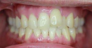 Your dentist also may require you to undergo whitening if you are planning other cosmetic dental procedures, such as veneers or composite bonding, in order to ensure a better match between the restoration and your natural dentition, or after the removal of braces. Zoom Whitening Everything You Need To Know 209 Nyc Dental