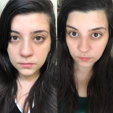 Breast Implant Illness and Explant Surgery Complications