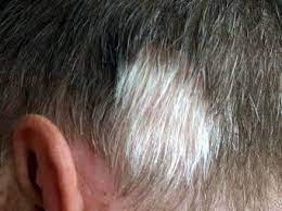 Natural aging processes can turn hair gray on the head, face, arms, and other areas of the body, and pubic hair is not immune to the change. White Pubic Hair Four Possible Causes