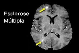 Observar inflamações ou infecções no. Esclerose Multipla Maligna Fatores Prognosticos Portal Tech4health