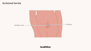 Related online courses on physioplus. Hernia Pictures Of 6 Common Types