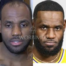 LeBron James Hair Transplant l Before and After