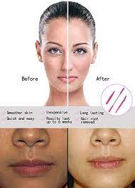 Upper lip hair is a common occurrence. Hair Removal Spring Kapmore Threading Hair Removal Removes Hair On The Upper Lip Chin Cheeks An Threading Hair Removal Eyebrow Shaping Natural Skin Care Diy