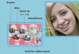 Check spelling or type a new query. Braces Diagram Olympus Pointe Orthodontics Garri Tsibel Dds