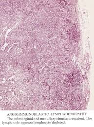 Atcl is more common in the elderly, and the average age at diagnosis is 62. Pathology Outlines Angioimmunoblastic