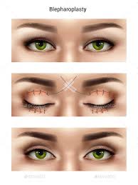 Blepharoplasty Suture Stitches Composition Surgical Suture Aesthetic Dermatology Sutures